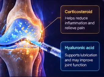 Illustration of Cingal treatment within the knee joint